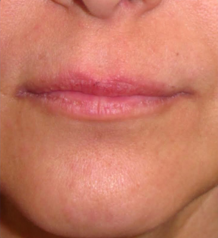Before-AH Perfilado labios